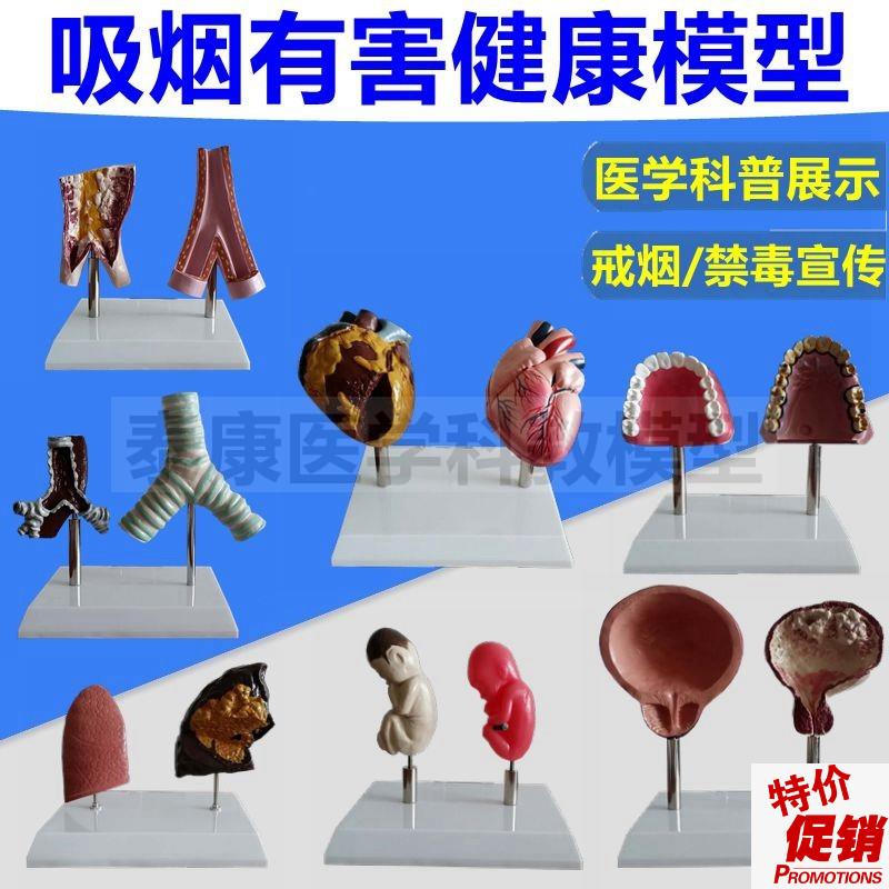 戒烟教育模型吸烟有害健康人体器官受损心脏血S管肺气管膀胱牙齿