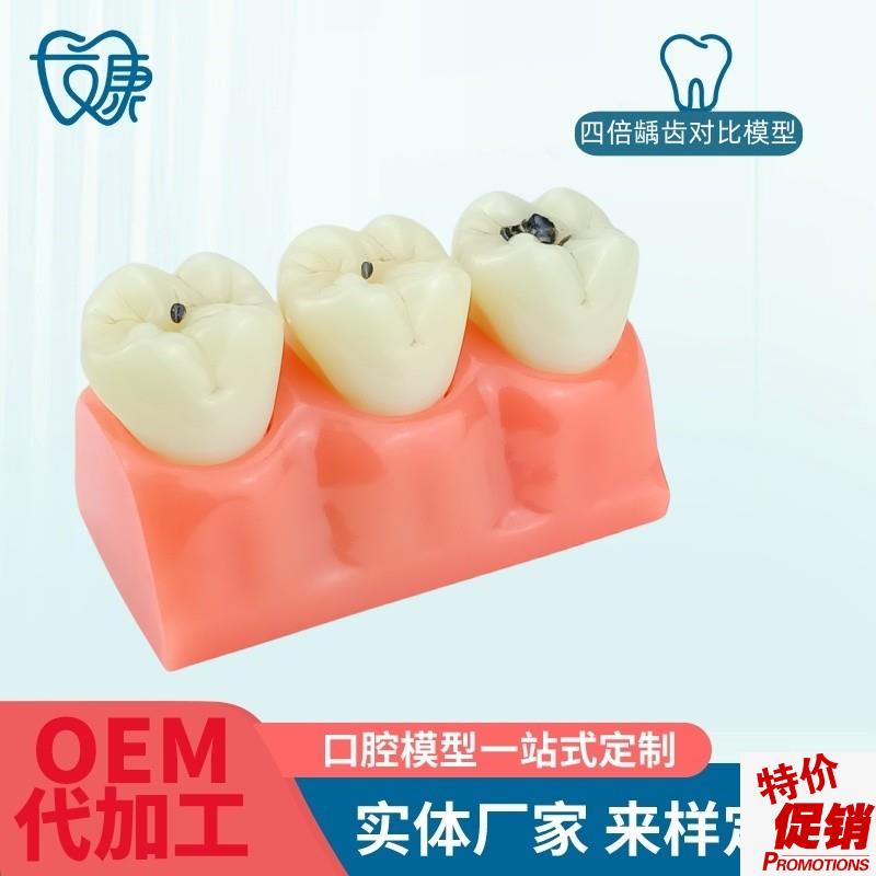 牙模型牙科口腔教学模型窝沟封闭模型龋齿对U比模型龋齿模型