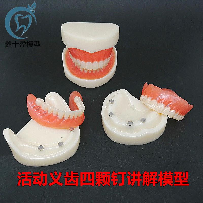牙科模型活动义齿牙模讲解模型全口义G齿四颗钉教学模型T21包邮