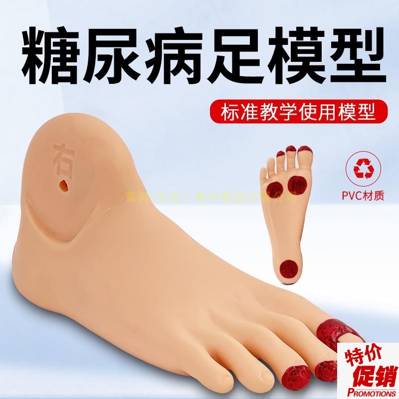 糖尿bing足护k理模型观察足部病理变化教具足部病变护理模型