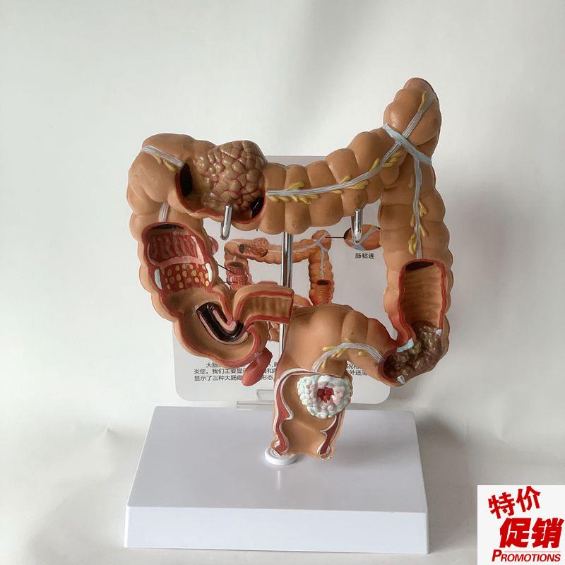 康泰医学模型人体肠道肛管u病理扭转梗阻痉挛大肠医药促销痔疮医