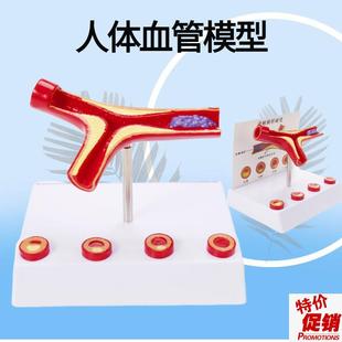 堵塞血管血液浓度脂肪r病理血液血管粥样人体血管病理解剖模型