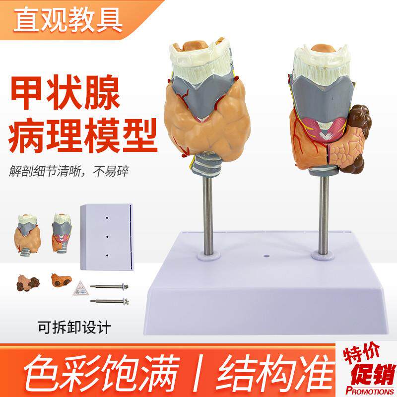甲状腺病理模型病态喉头解剖模型G甲状腺病变模型甲状腺模型