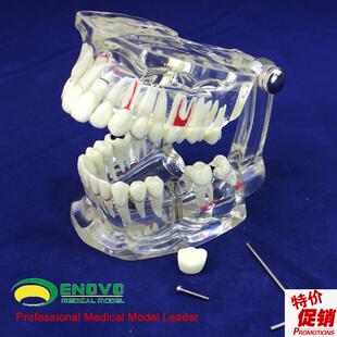 ENOVaO颐诺牙齿模型口腔牙齿科种植模型口腔病理模型种植体牙冠义