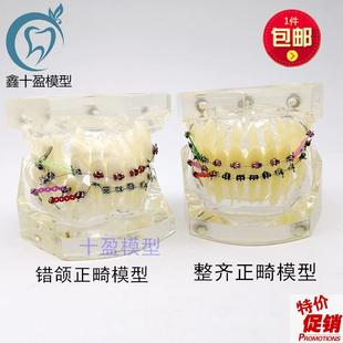 牙科正畸模型透明错颌矫正展示模型F结扎丝托槽正畸带支抗钉牙列