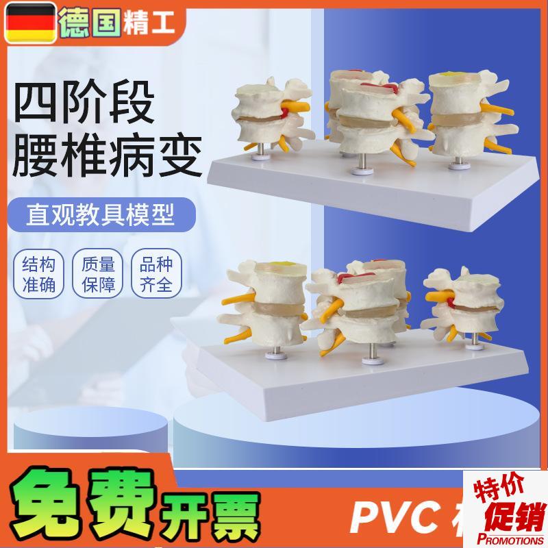 德国】人体腰椎模型四阶段腰椎对比椎间盘突出R脱出演示模型骨科
