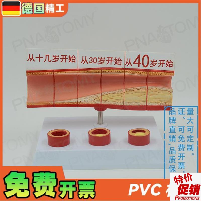 德国】人体d动脉血管堵塞模型心脑血管血栓/硬化模型教学心脑血管