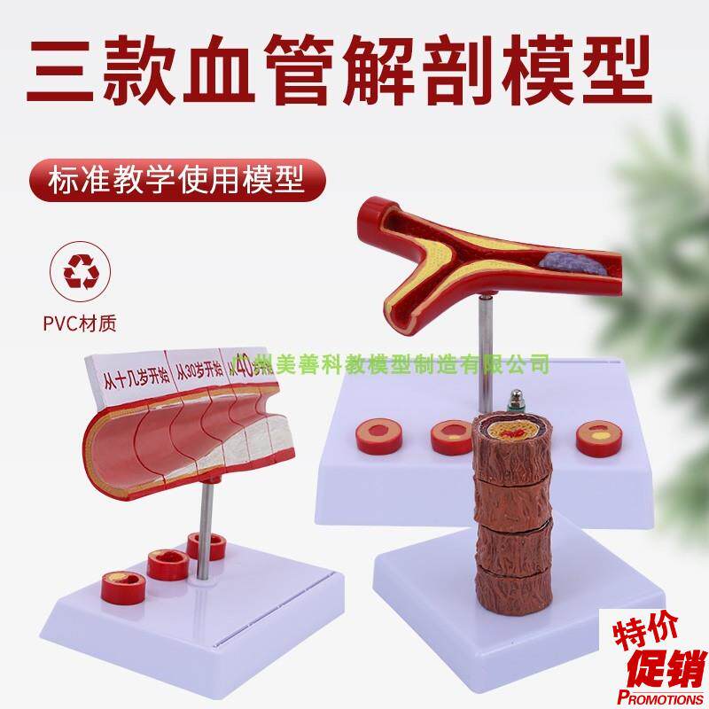 血管/堵塞动支i脉粥样/硬化心血管动脉/硬化模型血管病理模型血栓