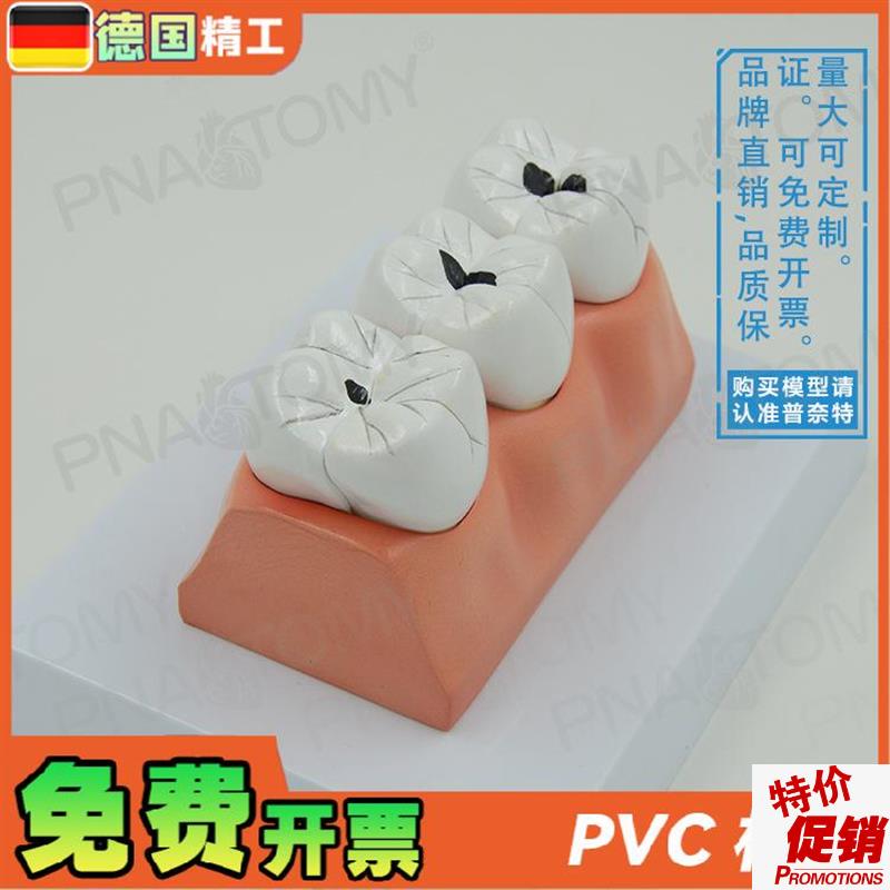 德国】牙科牙g齿龋齿解剖分解模型口腔科牙科病理蛀牙模型教学展