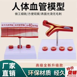 人体支脉粥样硬化人体血管血管模型血管堵塞b老年人血管病理模型
