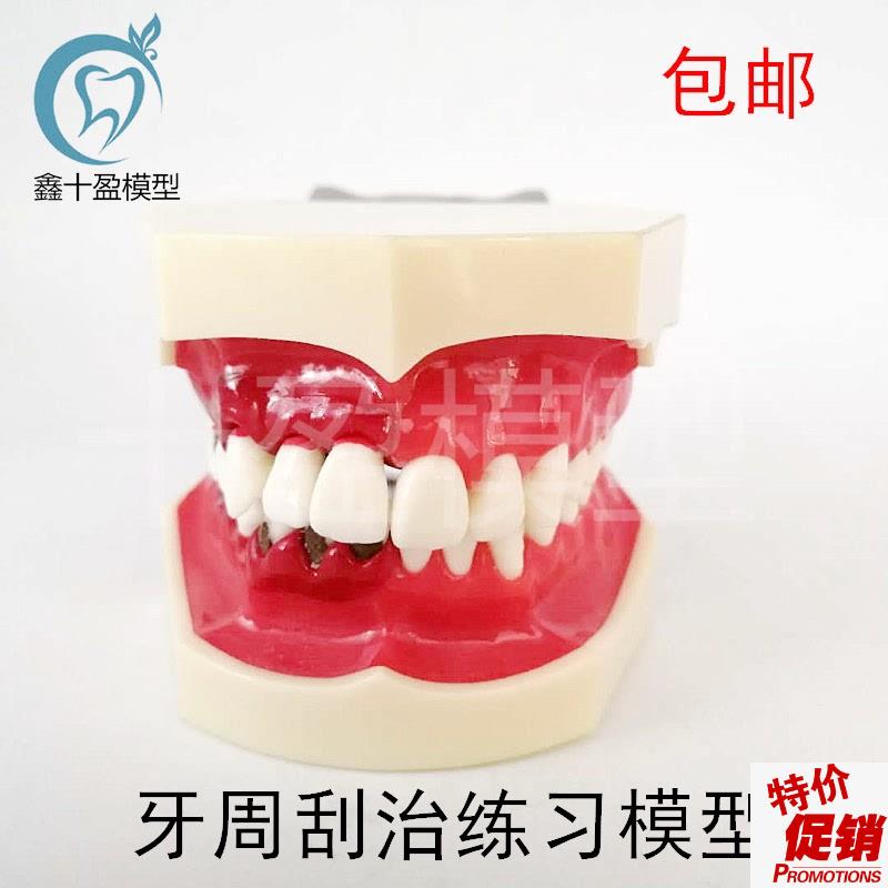 牙科牙结石刮治练习龈下去除模型牙周病理K模型医患教学教具4025