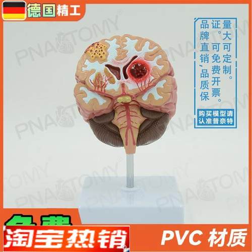 德国】人脑病理解剖模型脑geng大脑疾病血管P堵塞标本教学脑科神