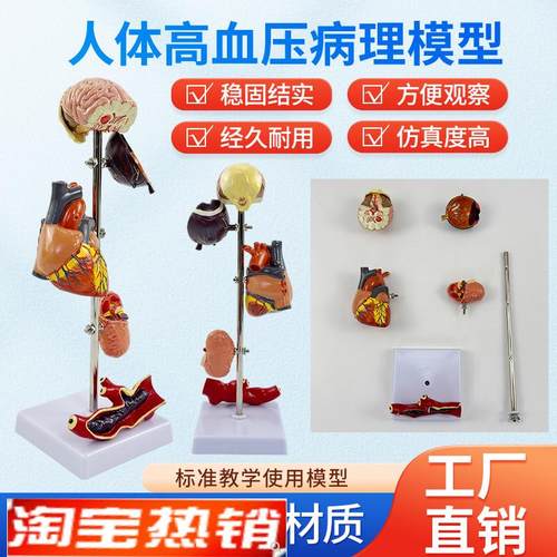 高/血压模型5部分病变内脏模型病态血压病Q理脑眼心脏肾脏血管