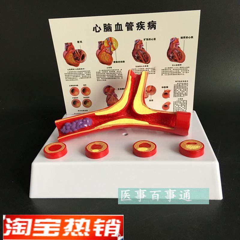 血管模型冠状动脉性心q脏病动脉化模型老年科医患沟通演示模型