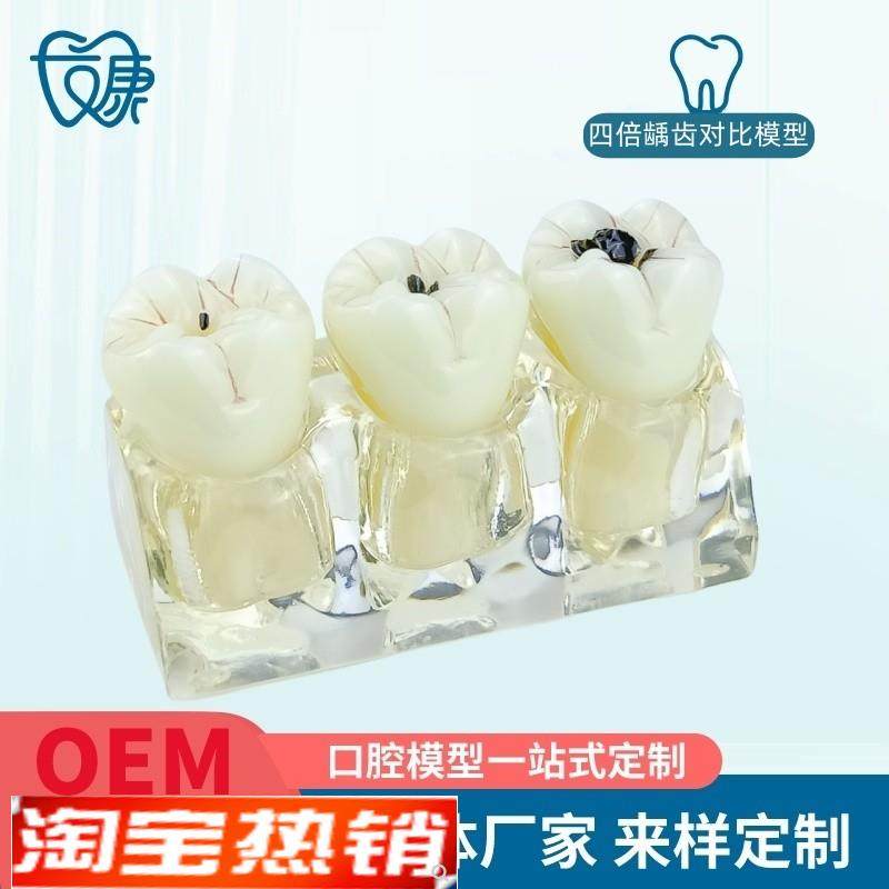 牙模型牙科口腔教m学模型窝沟封闭模型龋齿对比模型龋齿模型,美容美体仪器,口腔护理设备礼盒,淘宝优惠券,粉丝福利购,淘宝优惠卷
