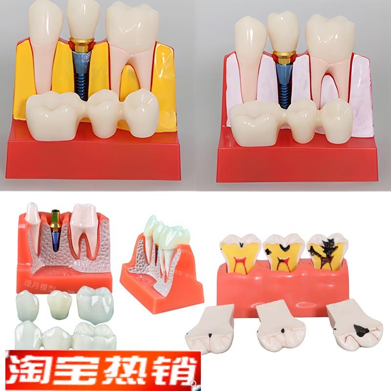 4次种植及解说模型口腔牙齿模型牙C冠可移动种植钉展示模型医学通