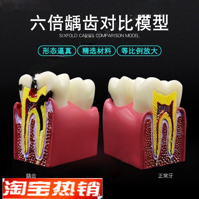 牙科口腔模型解剖放大蛀牙w模具医患沟通六倍牙齿龋坏病理演示