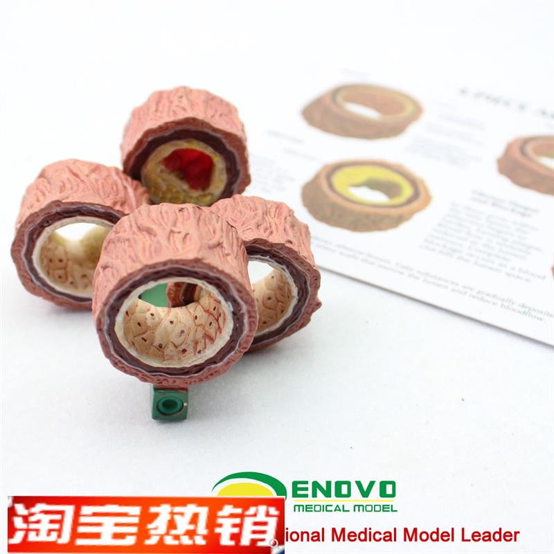 颐诺正品动脉粥样硬化模型血栓病变模型心T血管模型内科学