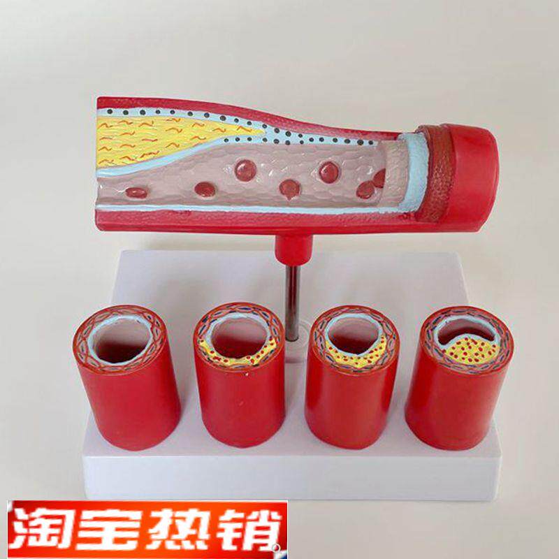 康泰模型动脉血管壁粥样硬化红细胞脂肪斑块阻塞U狭窄心血管病理