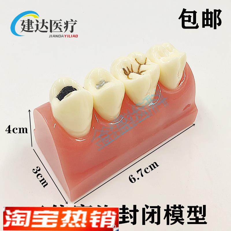 牙科教学模型窝沟封闭模型儿童防C蛀龋坏牙齿模型窝沟封闭操作示,文具电教/文化用品/商务用品,教学仪器/实验器材,淘宝优惠券,粉丝福利购,淘宝优惠卷