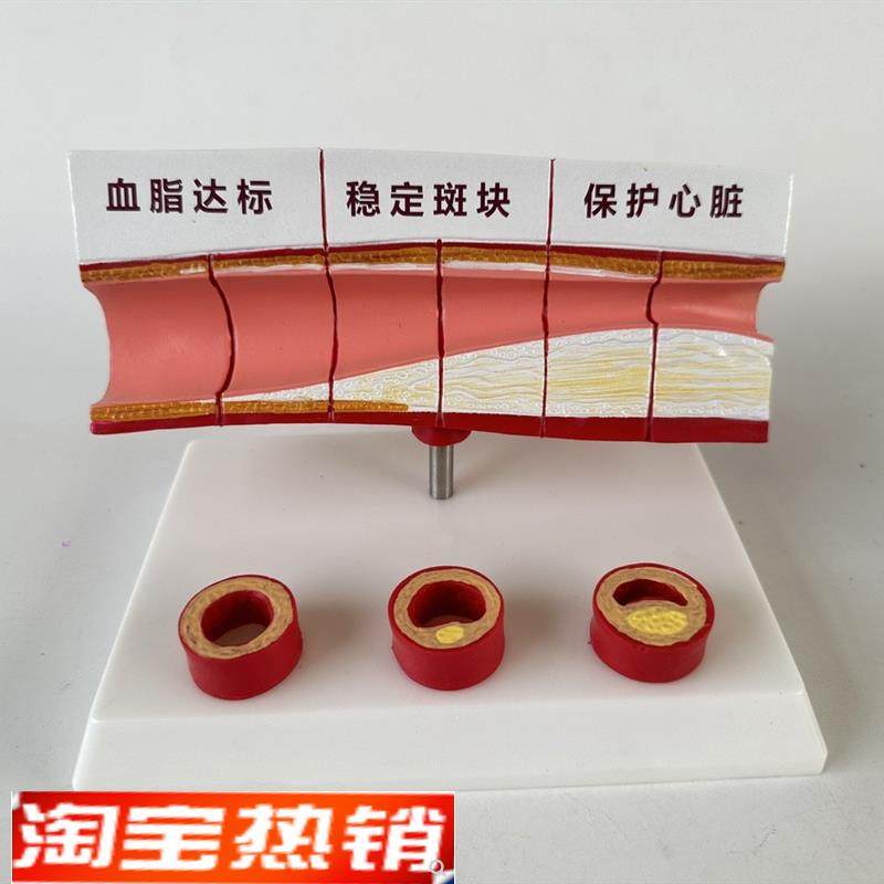 血管/堵塞动支脉粥样/硬化心血管动脉H/硬化模型血管病理模型血栓