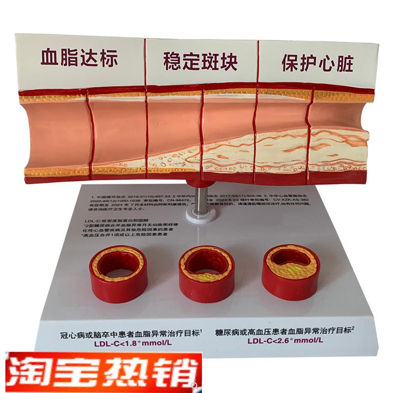 血管活动堵塞动支脉粥样硬化心血管动脉H硬化模型血管病理模型血