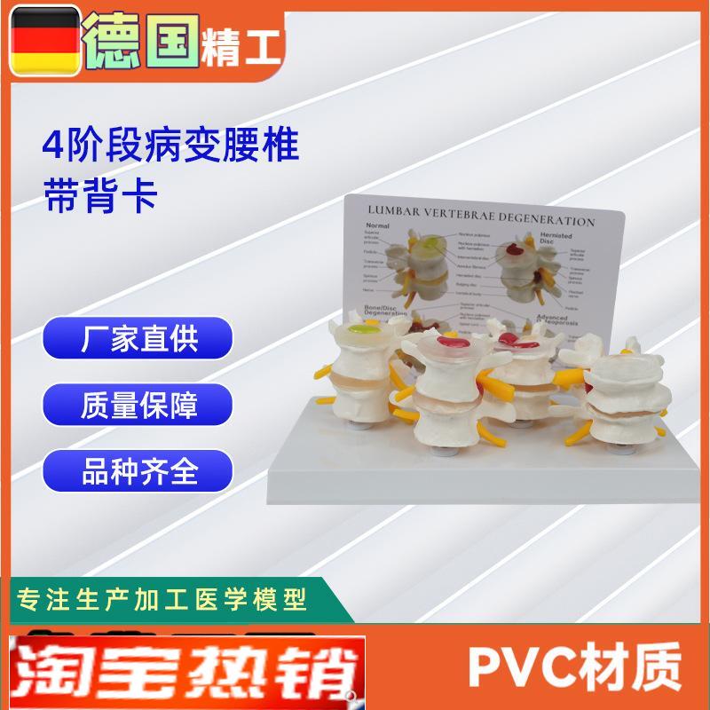 4阶段病态腰椎比较模型带背卡骨科X教学展示教具