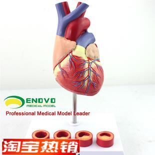 颐诺正品1d:1医用人体心脏模型动脉粥样硬化模型血栓心内科教学