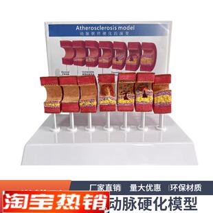 7节动脉粥样硬化模型血管血栓栓塞演示模型人体血管Y模型医用教具