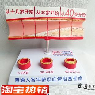 人体支脉粥样硬化和q血栓形成模型人体模型病态血管模型