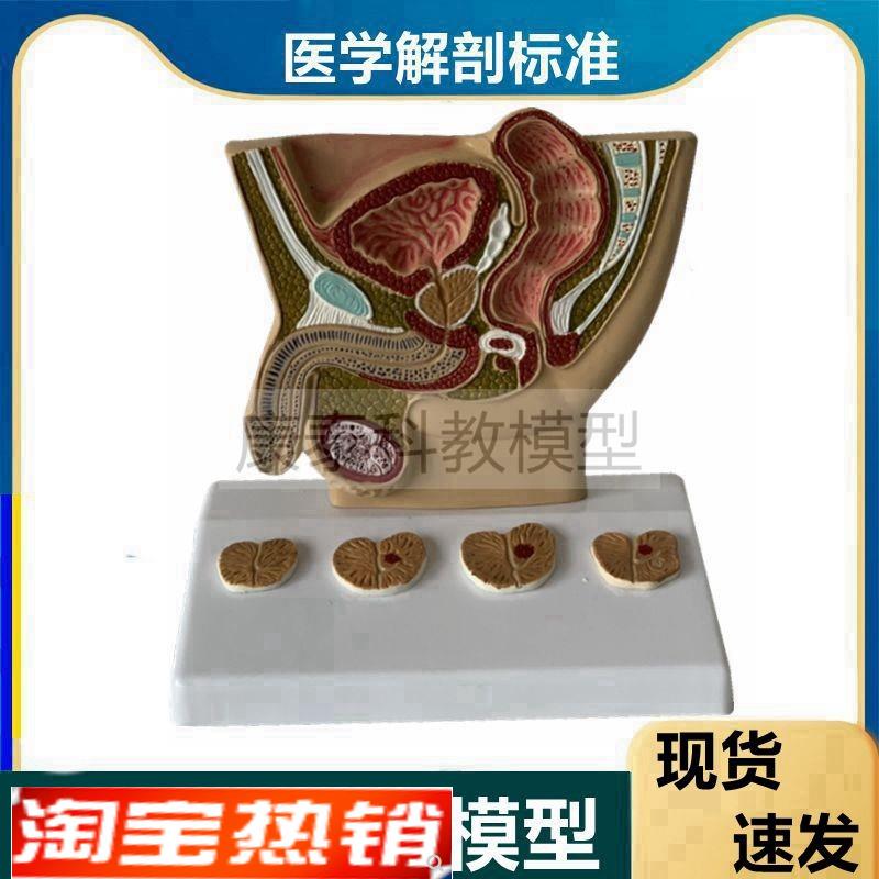 医生用男性前列腺病变模型四个阶段男科医药礼R品增大肥泌尿生殖