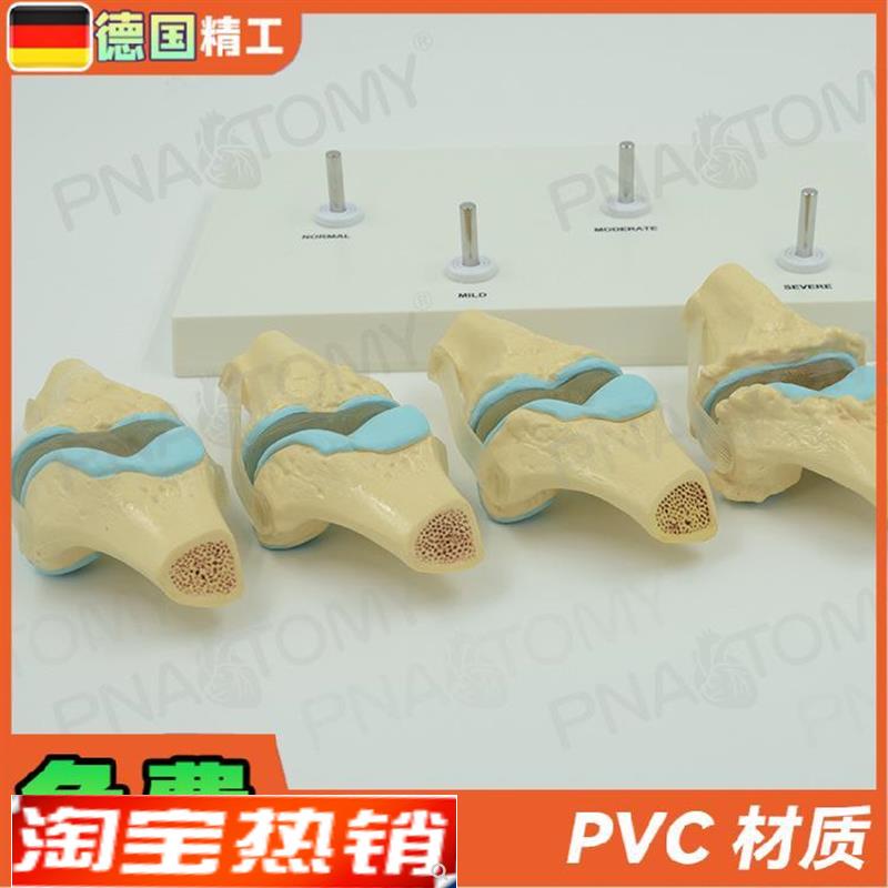 德国】人体膝关节骨骼/病u理模型关节骨质/病变教学膝盖骨外科疼