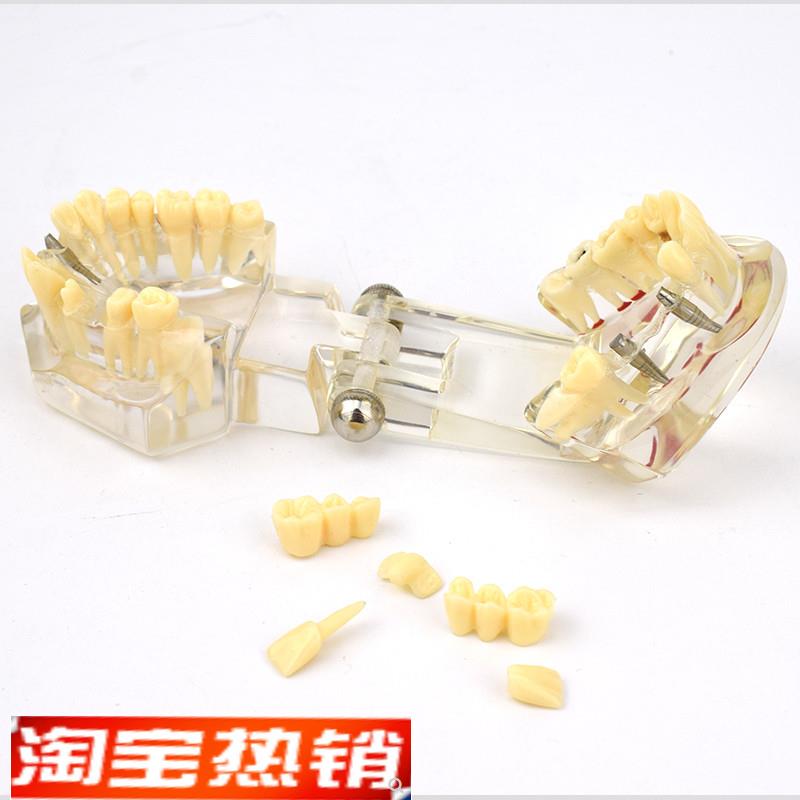 ENOVO颐诺口腔模型齿科x修复种植阻生齿牙体牙髓口腔教学