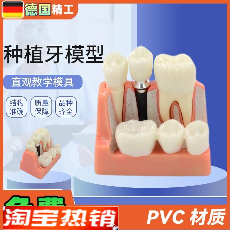 德国】种植牙模型人q体口腔牙齿模型透明牙模型牙种植模型