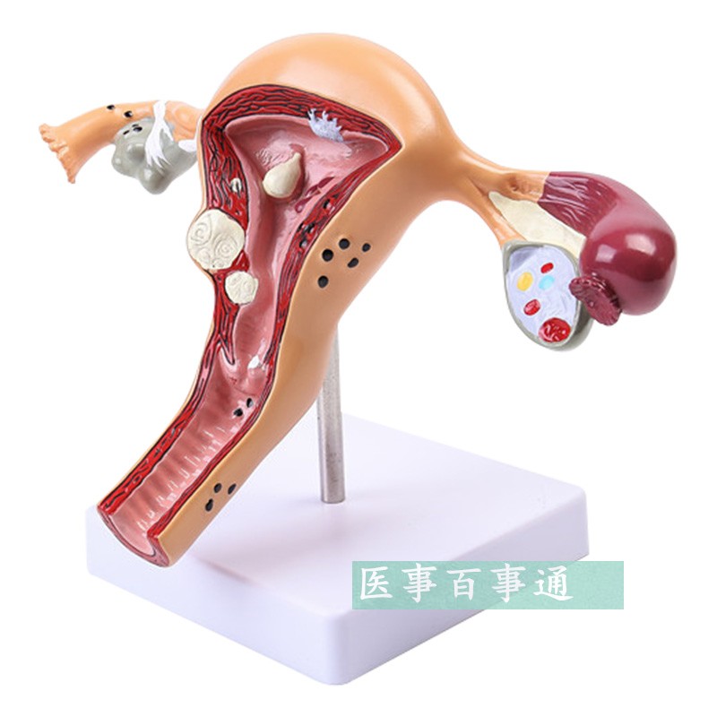 人体子宫模型生殖科妇科r医用演示模型 女性子宫阴道模型病理子宫