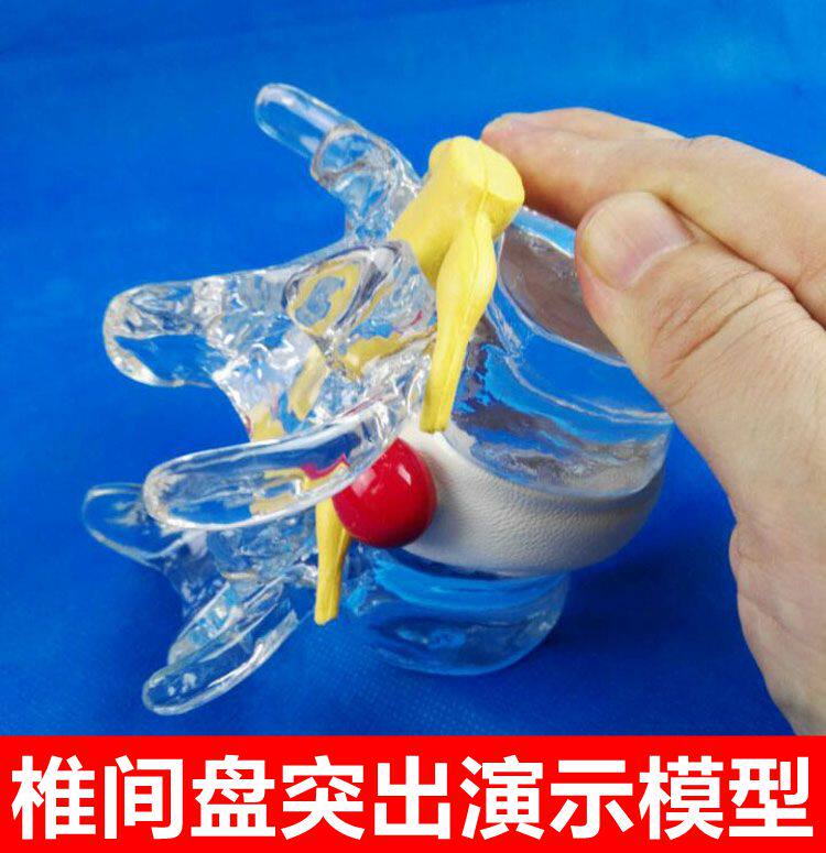 腰椎间盘受压突出演示模型压迫神经D脊椎骨劳损2节腰椎可拆卸病理