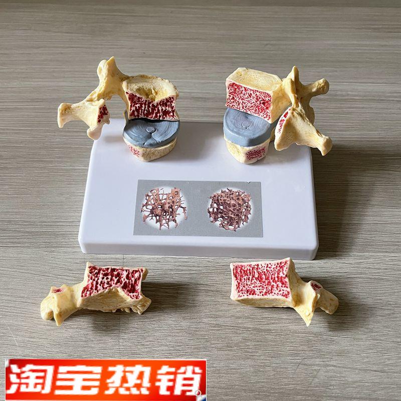 脊椎骨质疏松模型老年人骨骼仿真股骨头密度M腰椎变形劳损医患礼