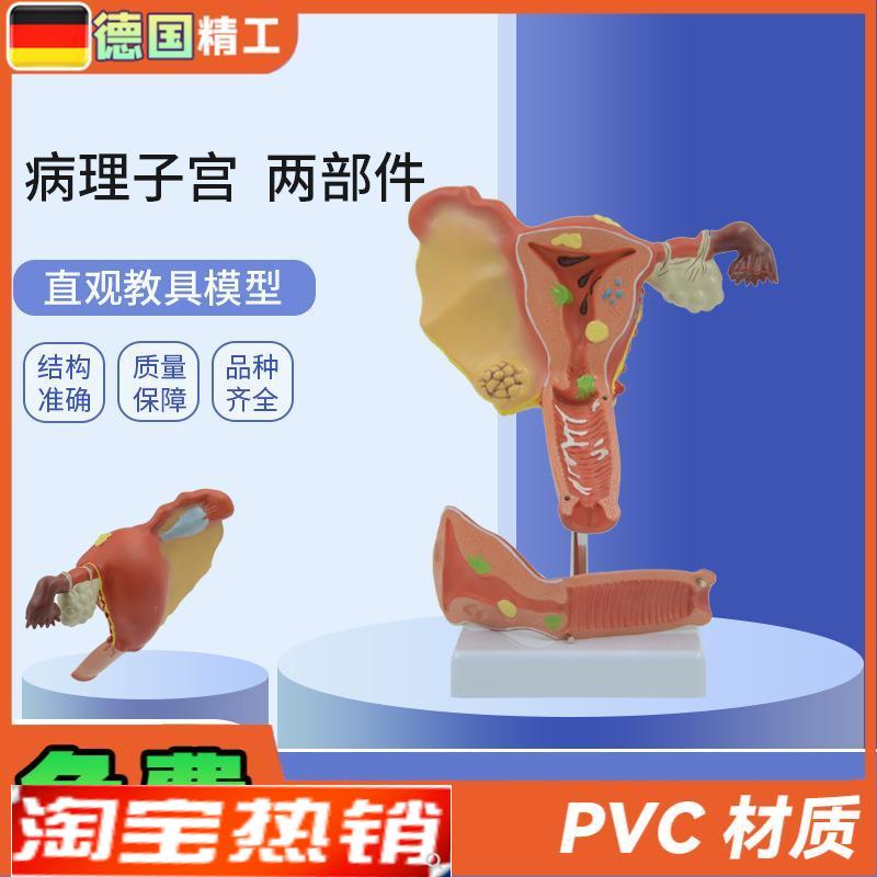 德国】PNT-07l43仿真子宫模型病理子宫输卵管结构病态子宫模型教