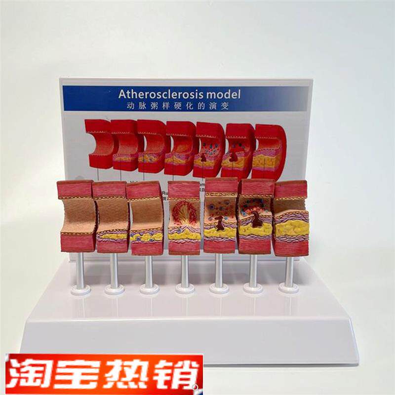 动脉血管模型粥样病理硬化血管壁变细狭窄M内膜斑块沉积阻塞程度