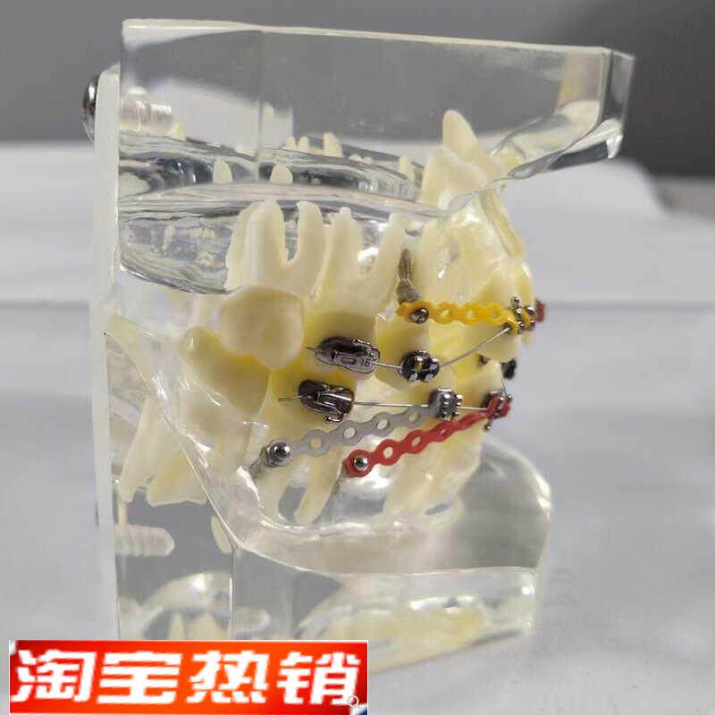 透明正畸撮合矫正模n型透明水晶托槽展示结扎丝托槽正畸带支抗钉