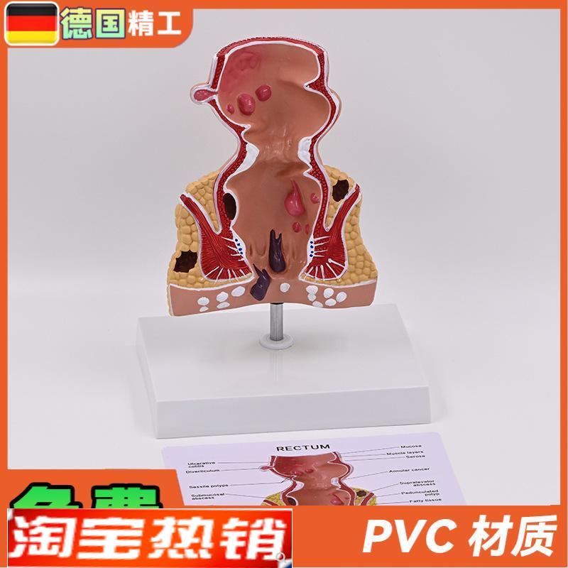 德国】新款e大促爆款人体模型肠直肠解剖病理模型病态疾病教具模
