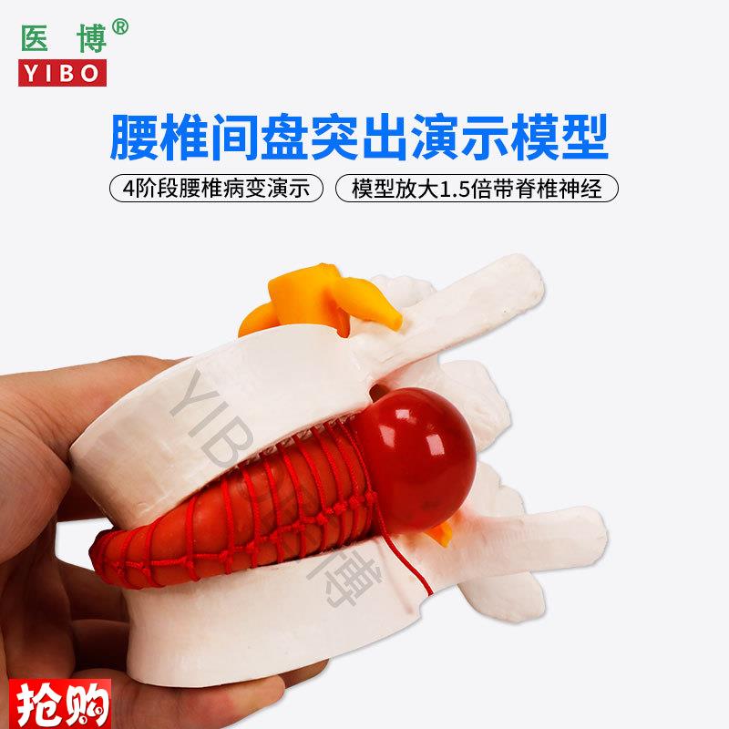 医博BIX-A3561人体腰椎间q盘突出病变演示模型人体脊柱腰椎模型人