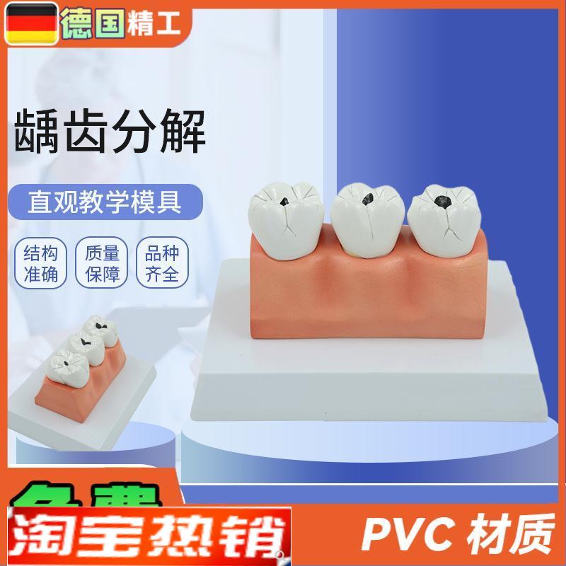 德国】龋齿病分解解剖模型牙齿模型口I腔牙保健护理模型牙科牙齿