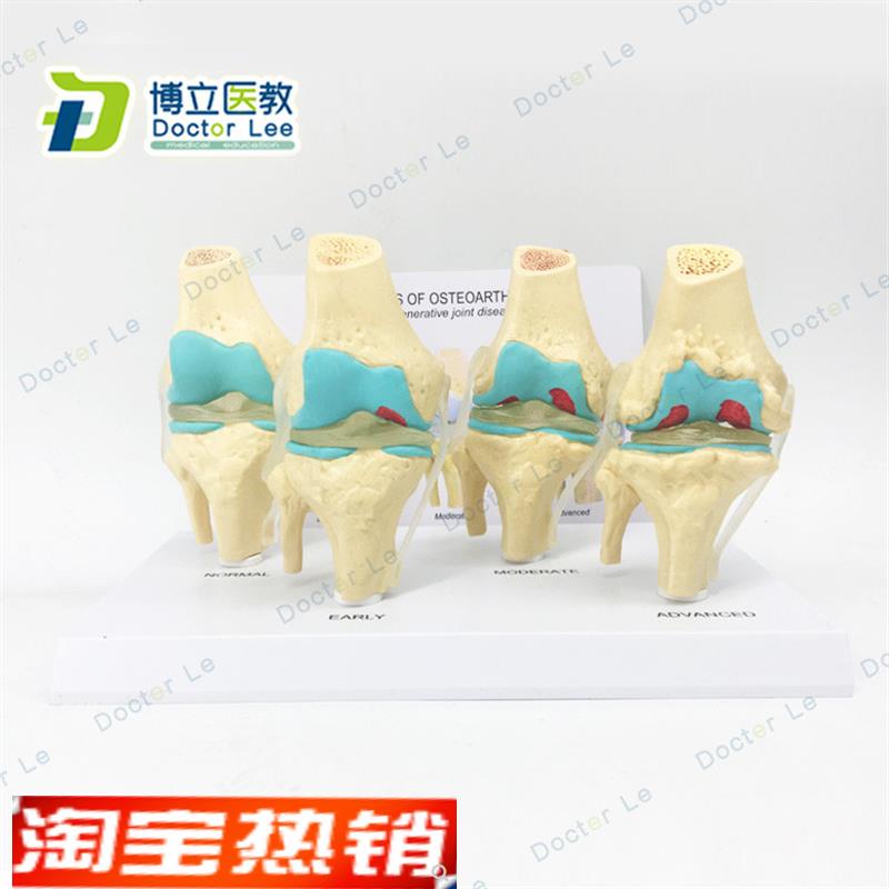 人体膝关节模型4n阶段膝关节病变模型四阶段病变膝关节模型