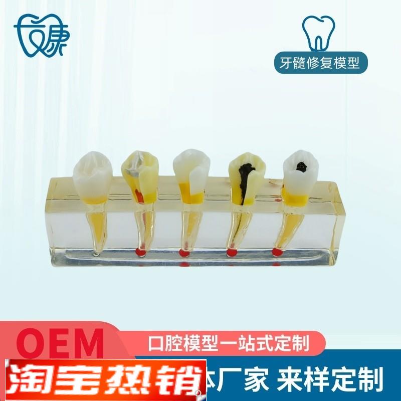 牙科医患沟通病理模型牙髓病修复F模型展示牙髓牙髓治疗模型