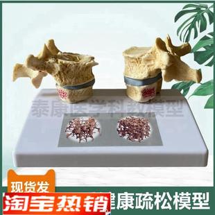 人体骨骼模型脊椎骨质p密度疏松老年人骨骼椎间盘压迫神经演示病