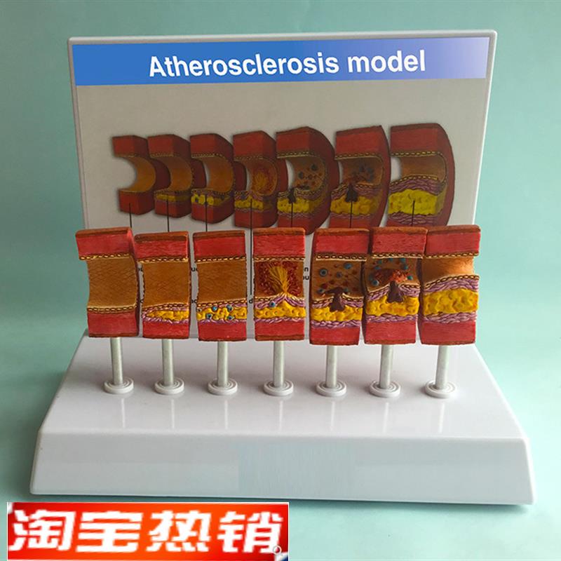 动脉粥样硬化模型血管血s栓栓塞模型动脉血管人体医用医学教学教