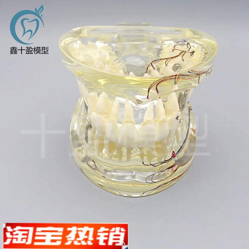牙科水晶牙e齿病理模型M4019-2成人透明病理牙模型带牙神经和嵌体