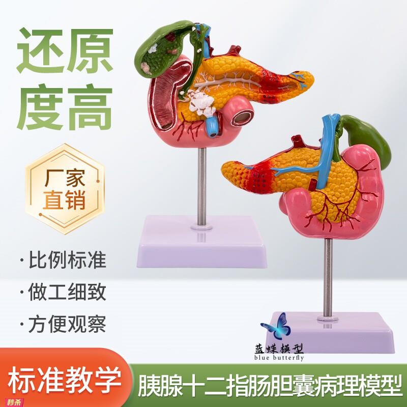教学医学胰腺十二指肠胆囊病理模型胆结石外科消化科系统肝胆胰脾