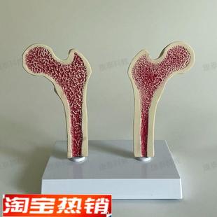 康泰医学模型股骨密度变r化骨质疏松比较长骨干解剖健康病变腿骨